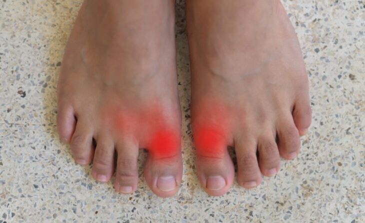 Pain in the big toes with arthritis
